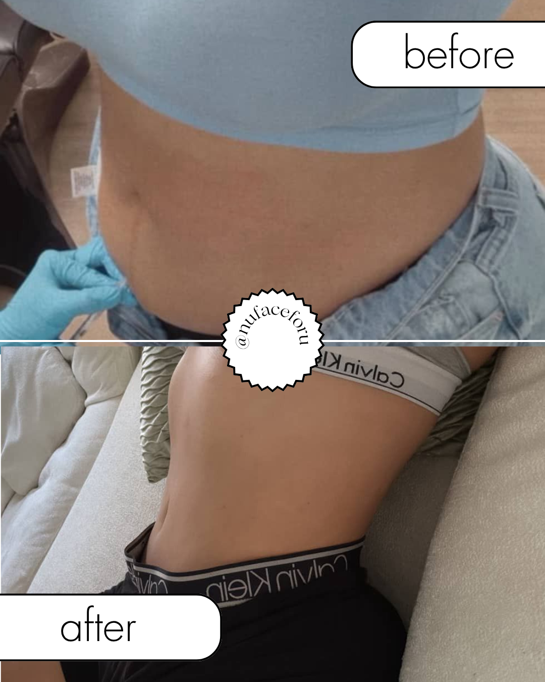 Tirzepatide- Monthly dosage